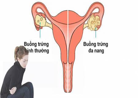Đa nang buồng trứng là nguyên nhân gây bệnh vô sinh nữ