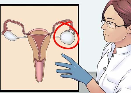 Biểu hiện bệnh u nang buồng trứng