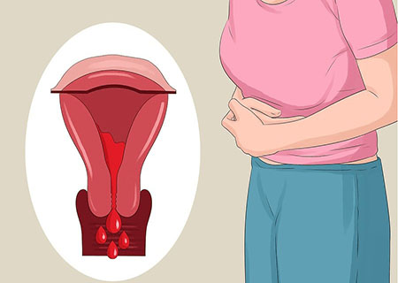 Tác hại của bệnh viêm nội mạc tử cung
