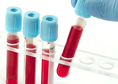 Xuất tinh ra máu phải làm xét nghiệm gì?