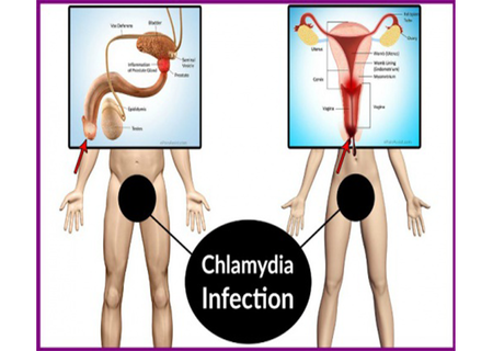 Bị chlamydia mãn tính