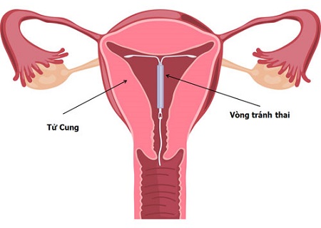 Các cách đặt vòng tránh thai