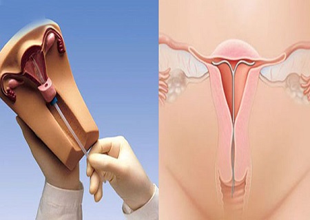 Phòng khám đặt vòng tránh thai ở đâu?