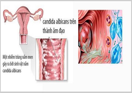 Nấm Candida ở âm đạo