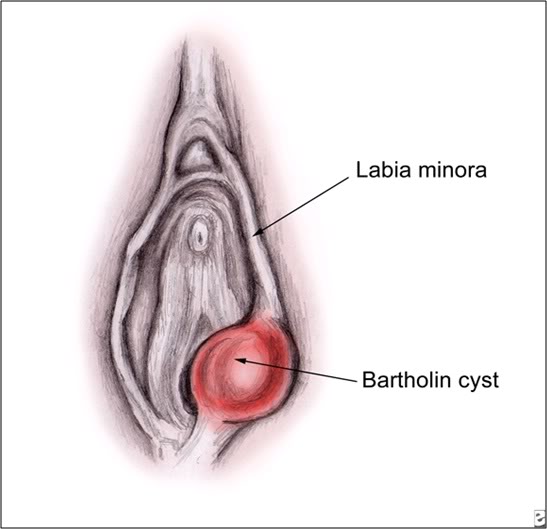 Hình ảnh viêm tuyến bartholin
