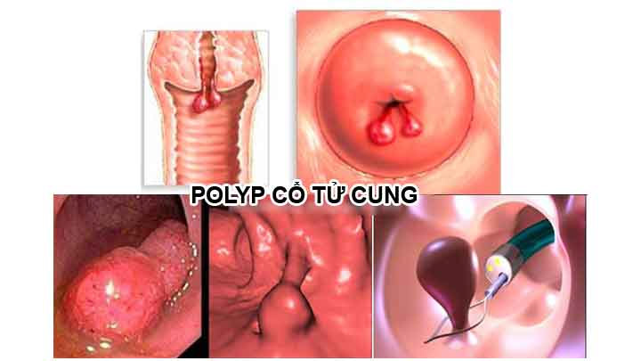 Trả lời: Bệnh Polyp cổ tử cung là gì?