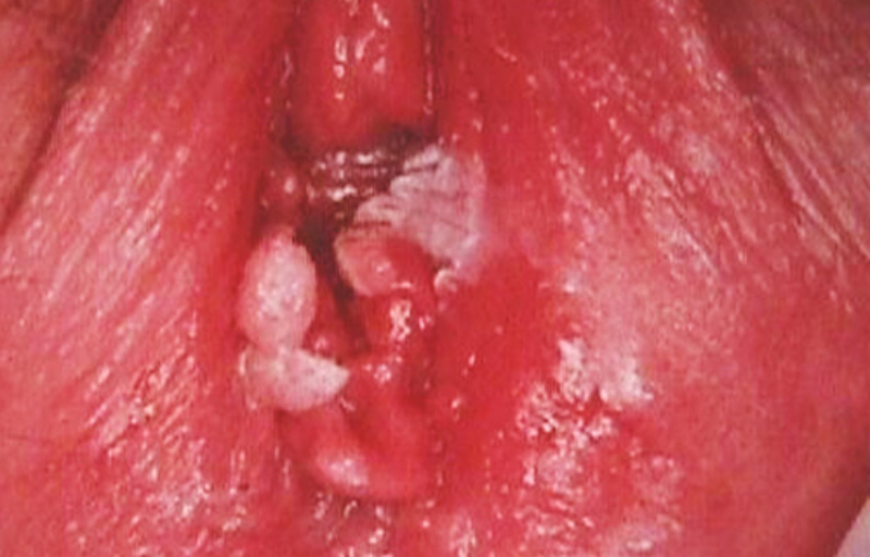 Hình ảnh viêm âm đạo bị sưng đỏ do viêm nhiễm