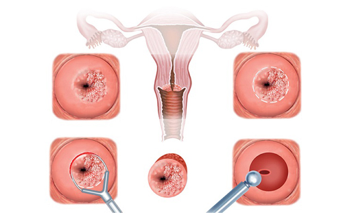 Phương pháp chữa viêm lộ tuyến cổ tử cung