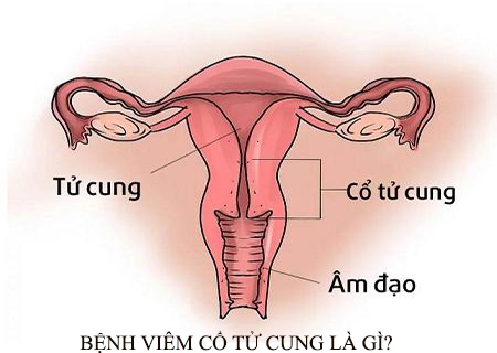 Bệnh viêm cổ tử cung là gì?
