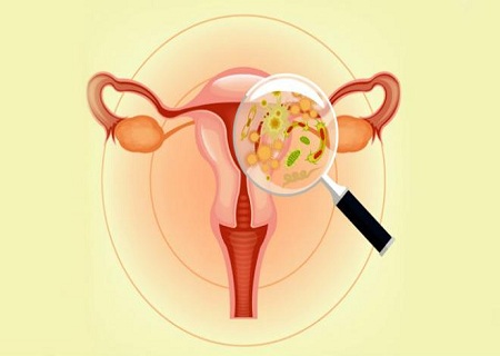 Điều trị viêm âm đạo cho phụ nữ có thai