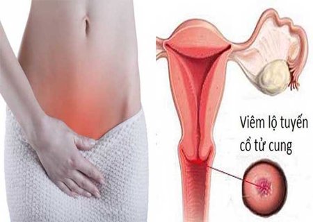Phương pháp điều trị viêm cổ tử cung