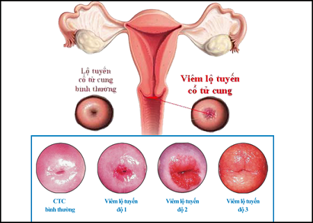 Tìm hiểu về bệnh viêm lộ tuyến tử cung