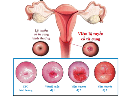 Những cấp độ của viêm lộ tuyến cổ tử cung