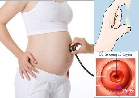 Chữa viêm lộ tuyến cổ tử cung khi mang thai