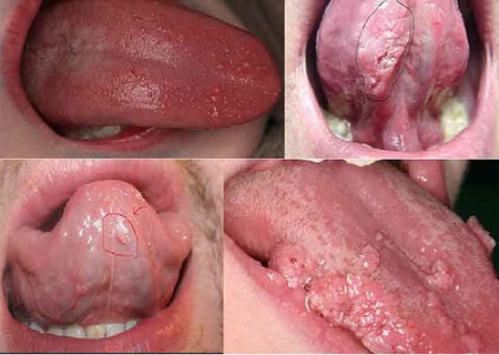 Dương tính với HPV vì quan hệ tình dục bằng miệng