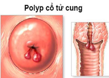 trieu-chung-polypXoắn polyp cổ tử cung ở đâu tốt-co-tu-cung