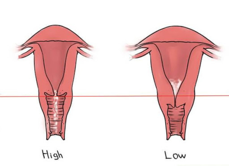 Chuyên gia giải thích: Tử cung cao làm khó thụ thai