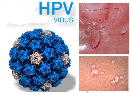 Bị nhiễm virus HPV- Nguyên nhân, cách nhận biết & phương pháp điều trị