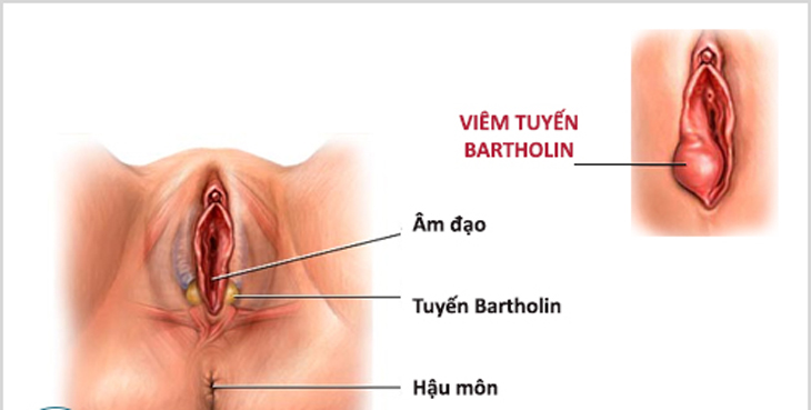 Viêm tuyến bartholin tái phát